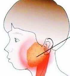 痄腮的症状及治疗方法 痄腮的症状 多种方法治痄腮