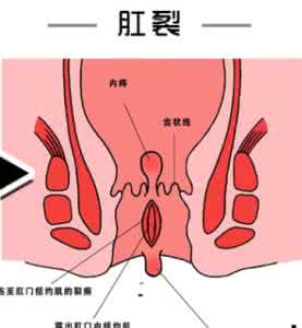 一图读懂 一图读懂 | 如何应对痔疮