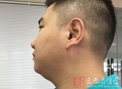 获得性皮肤松弛症 获得性皮肤松弛症 什么是获得性皮肤松弛症