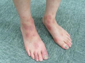 湿疹的最佳治疗法 湿疹的最佳治疗法 成人湿疹最佳疗法