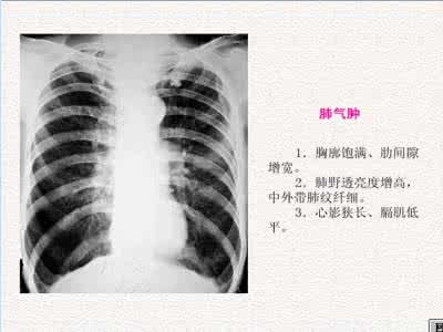 肺气肿严重吗 肺气肿严重吗 肺气肿是怎么引起的
