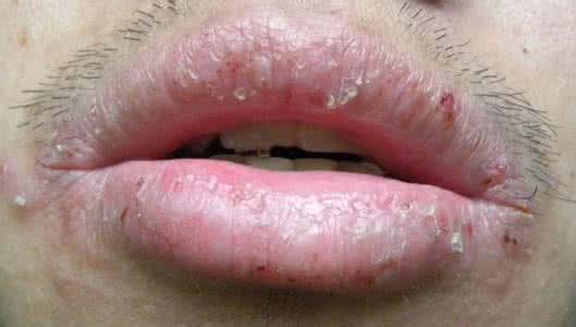 剥脱性唇炎 剥脱性唇炎 是什么引起的剥脱性唇炎