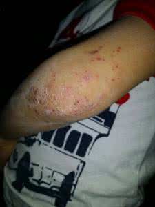 皮肤病800个秘方 皮肤病方（38个）