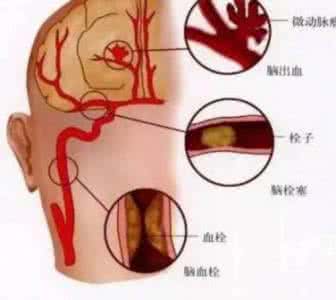 脑血栓嘴歪艾灸哪里 脑血栓嘴歪怎么恢复？