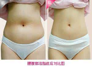 腰部肥胖抽脂 腰部肥胖抽脂 为什么胖都胖在腰部