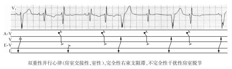 窦性心律室内传导阻滞 窦性心律传导阻滞 多重性并行心律、与束支阻滞有关的室性并行心律