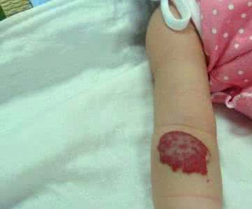 肝脏血管瘤危险吗 肝脏长血管瘤危险吗 肝脏血管瘤危险吗 如何治疗肝脏血管瘤