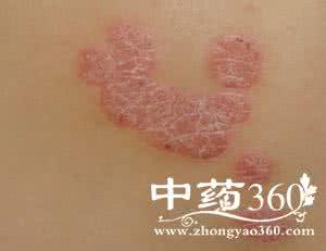 李时珍祖传治百病偏方 【转载】家传牛皮癣偏方!