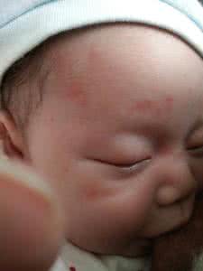 婴儿湿疹 长了湿疹怎么尽快消退 新妈妈不知所措的婴儿湿疹，这些知识尽快学