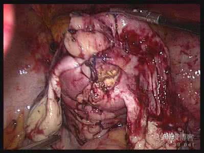 腺肌症是怎样引起的 腺肌症是由什么引起的？