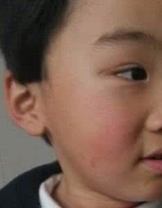 怎样去掉青春痘疤痕 怎么去脸上的疤痕 青春痘疤痕怎么去除