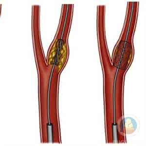 心肌梗死溶栓指南 急性心肌梗死后，是选择溶栓？还是PCI?