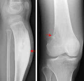 骨刺的最好治疗方法 骨刺的最好治疗方法 骨刺的最好治疗方法 这样治疗骨刺效果好