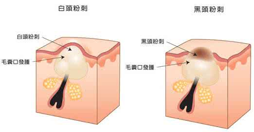 闭合性粉刺吃什么药 闭合性粉刺可以吃什么药