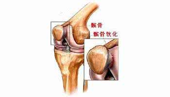 髌骨软化是什么意思 髌骨软化 造成髌骨软化的原因是什么
