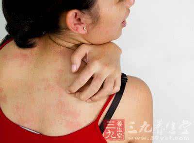 冬天皮肤痒怎么治 皮肤瘙痒怎么办 为什么皮肤会越挠越痒