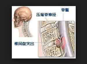 腰颈椎间盘突出 腰、颈椎间盘突出不复发的秘密