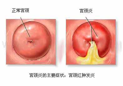 滴虫性阴炎是怎么引起 淋菌性阴道炎是怎么引起的