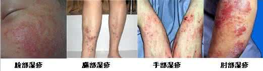 湿疹有几种类型和图片 常见湿疹有10种类型