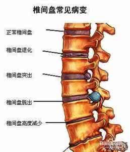 腰椎间盘突出能否根治 腰椎间盘突出如何根治 腰椎间盘突出能否根治三个环节缺一不可