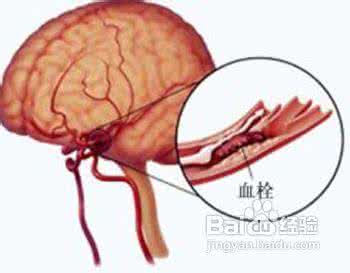 脑血栓要注意什么 脑血栓要注意什么 脑血栓的饮食禁忌