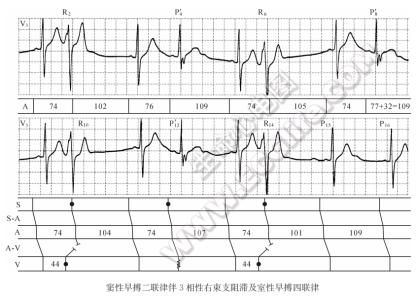 室性早搏二联律 室性早搏二联律 窦性早搏二联律伴3相性右束支阻滞及室性早搏四联律心电图精解
