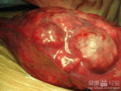 肝癌的晚期症状及表现 肝癌晚期是什么症状 这些表现就是肝癌晚期