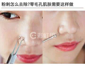 粉刺怎么彻底去除调理 粉刺怎么去除?解决粉刺的方法