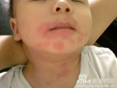 婴儿湿疹的症状 婴儿湿疹误区 湿疹症状的误区有哪些