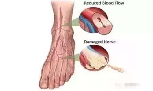 脚血管堵塞 血管堵塞怎么治疗 脚冷，可能是血管堵了，这个小动作可解决