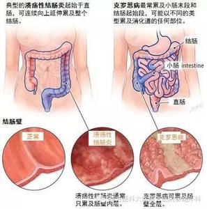 妇科炎症有哪些症状 肚子里有炎症什么症状？