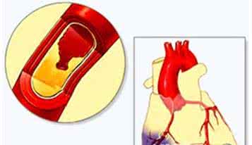 中医治疗动脉硬化 【中医处方】动脉硬化好健忘，要想治疗有妙方