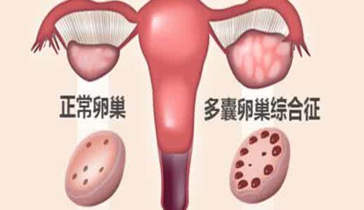 多囊卵巢综合症治疗 如何治疗多囊卵巢综合症?食疗方可治疗