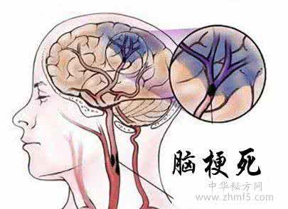 脑梗食疗 不幸患脑梗、食疗好轻松！