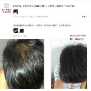 掉头发能长回来吗 掉头发能长回来吗 脱掉的头发长回来