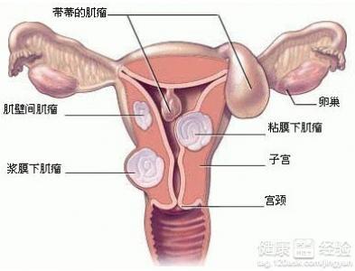 子宫囊肿要手术吗 患有子宫囊肿要不要做手术？
