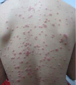 门诊pdca案例 高海荣：最新门诊牛皮癣案例