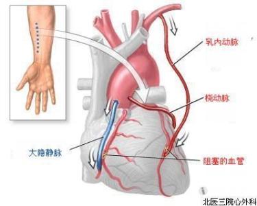 心脏支架手术后寿命 心脏支架手术后寿命 什么是心脏支架手术