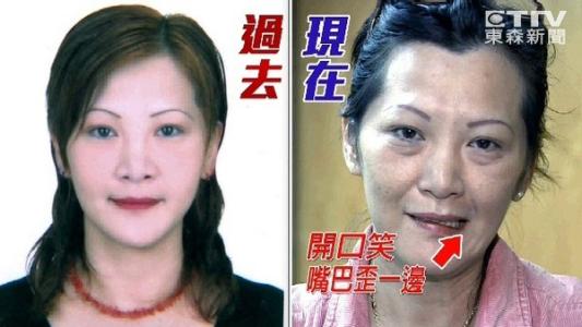 肉毒杆菌的危害 肉毒杆菌 肉毒杆菌的危害有哪些