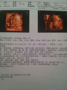 脐带绕颈有什么症状 脐带绕颈的病因 脐带绕颈的症状与处理