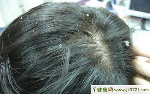 怎样去掉头皮屑小妙招 头屑如何去除
