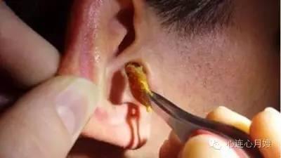 儿童挖出巨大耳屎 儿童的耳屎能挖吗？耳屎是怎么形成的？宝宝耳屎多怎么办？