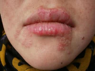 口周疱疹 口周疱疹1方