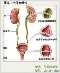 尿道狭窄的症状 尿道狭窄 尿道狭窄的症状与治疗
