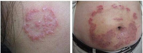 人得了猫癣症状图片 猫癣的症状及其治疗的方法