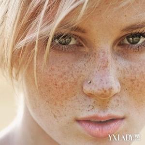 遗传性雀斑属于表皮 遗传性雀斑 属于遗传性疾病