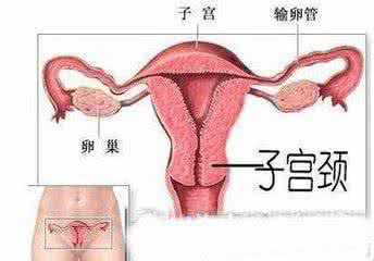 重度宫颈炎怎么引起 重度宫颈炎 重度宫颈炎是怎么引起的
