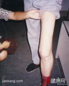 治疗肌肉萎缩偏方 肌肉萎缩如何治疗 如何护理肌肉萎缩疼痛