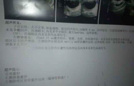 检查输卵管积液的价格 检查输卵管积液的价格 输卵管积液的检查