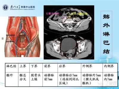 宫颈上皮内瘤变 宫颈管瘤变是什么意思？